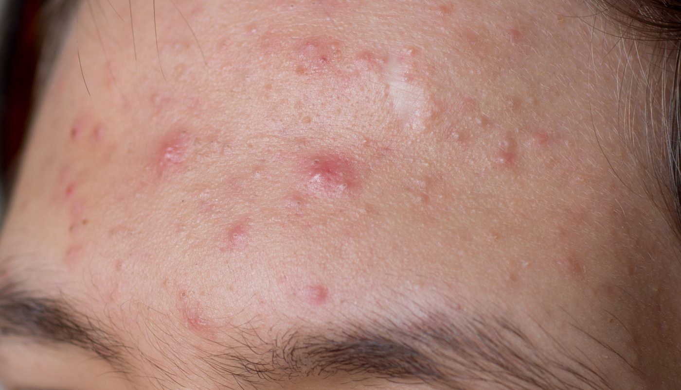 Acne and congestion skin treatment at Yuna Skin Clinic Melbourne