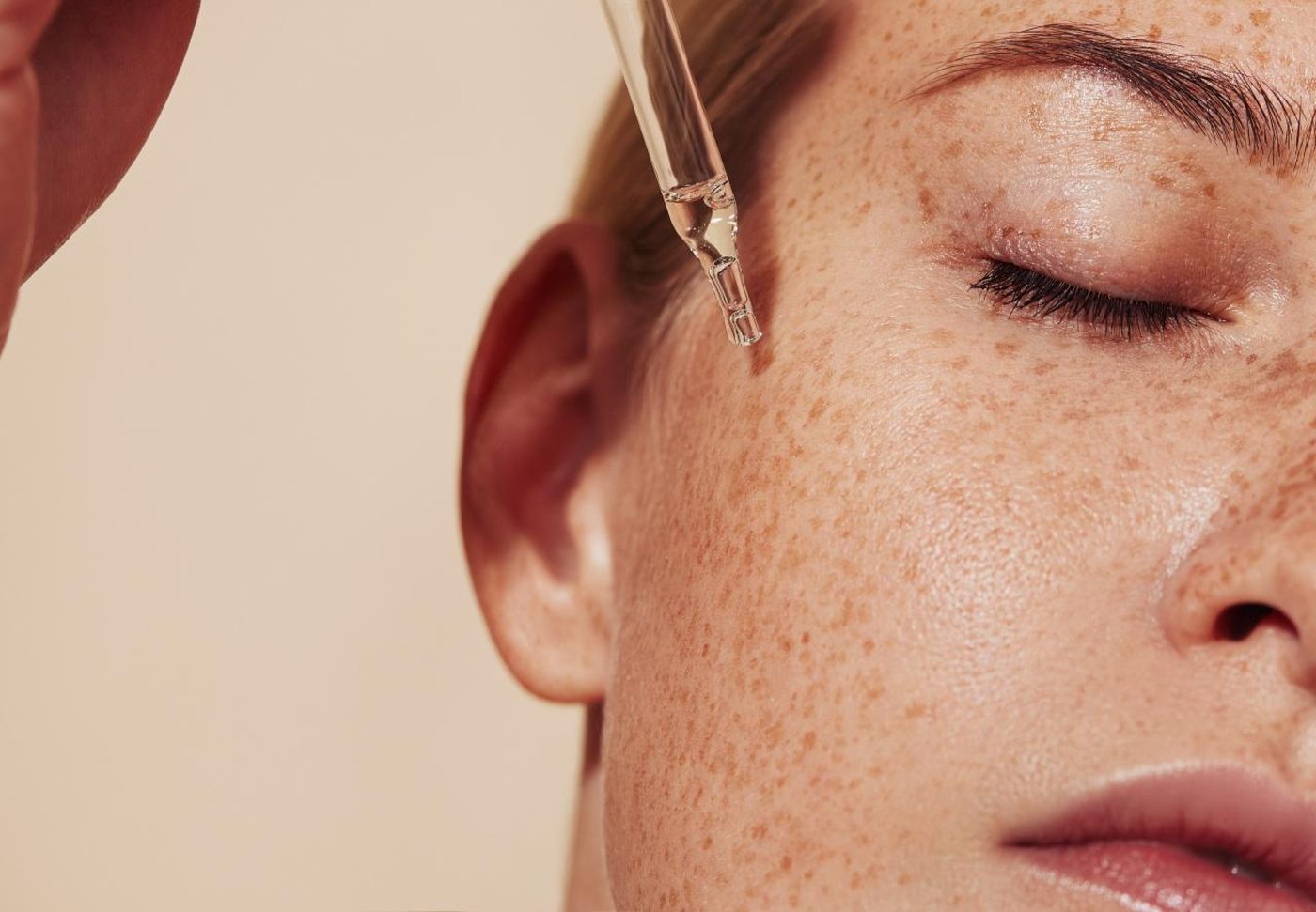 Holistic acne treatment approach at Yuna Skin Clinic Melbourne