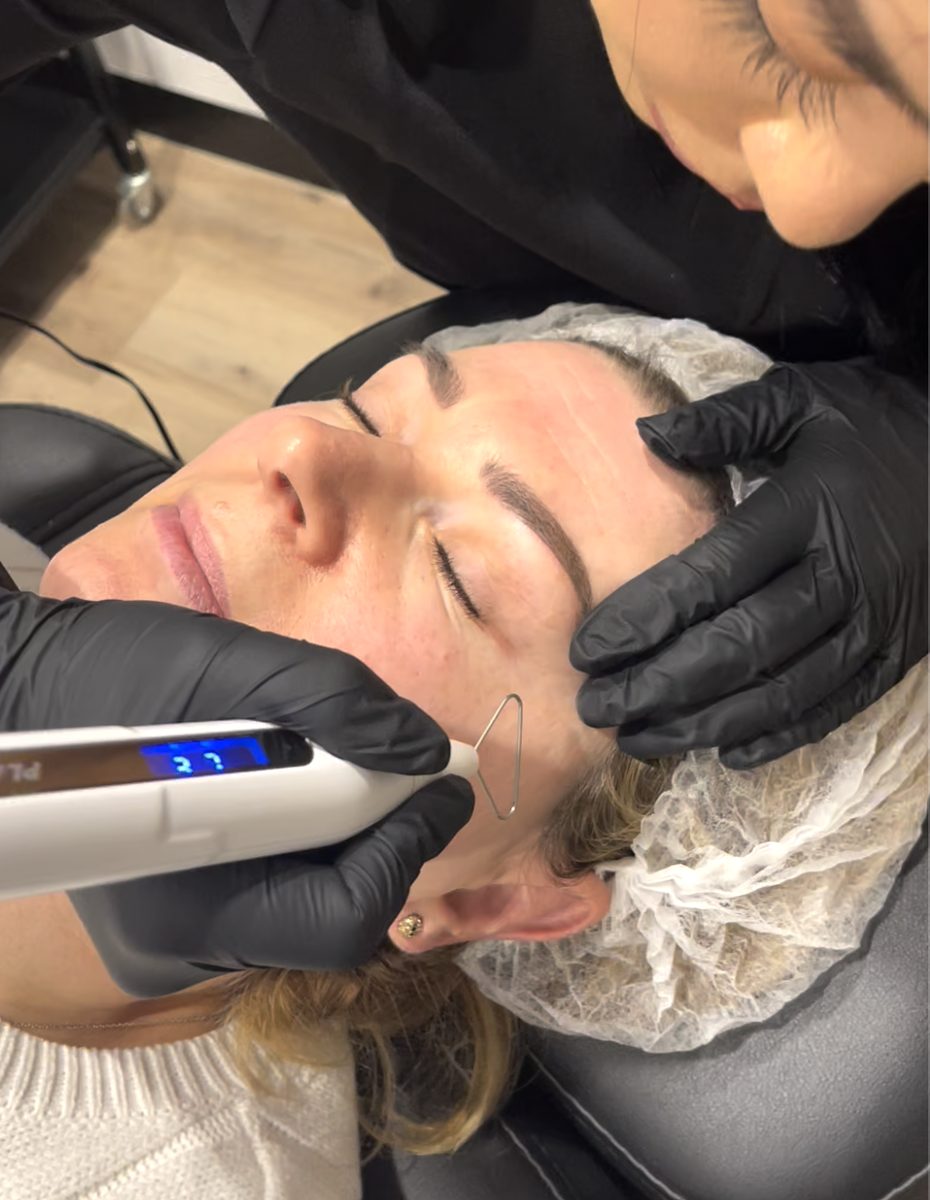 Korean Cold Plasma Facial