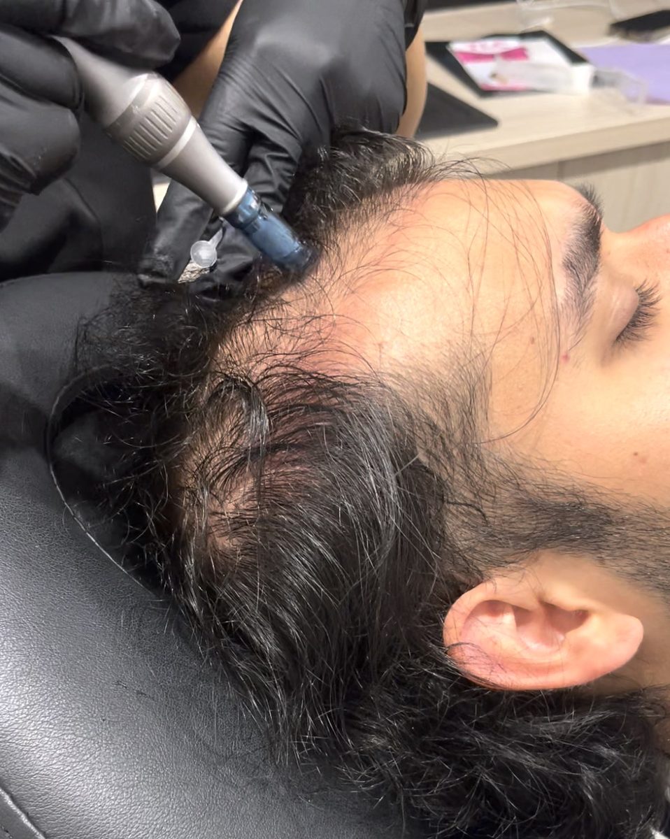 Scalp Treatment
