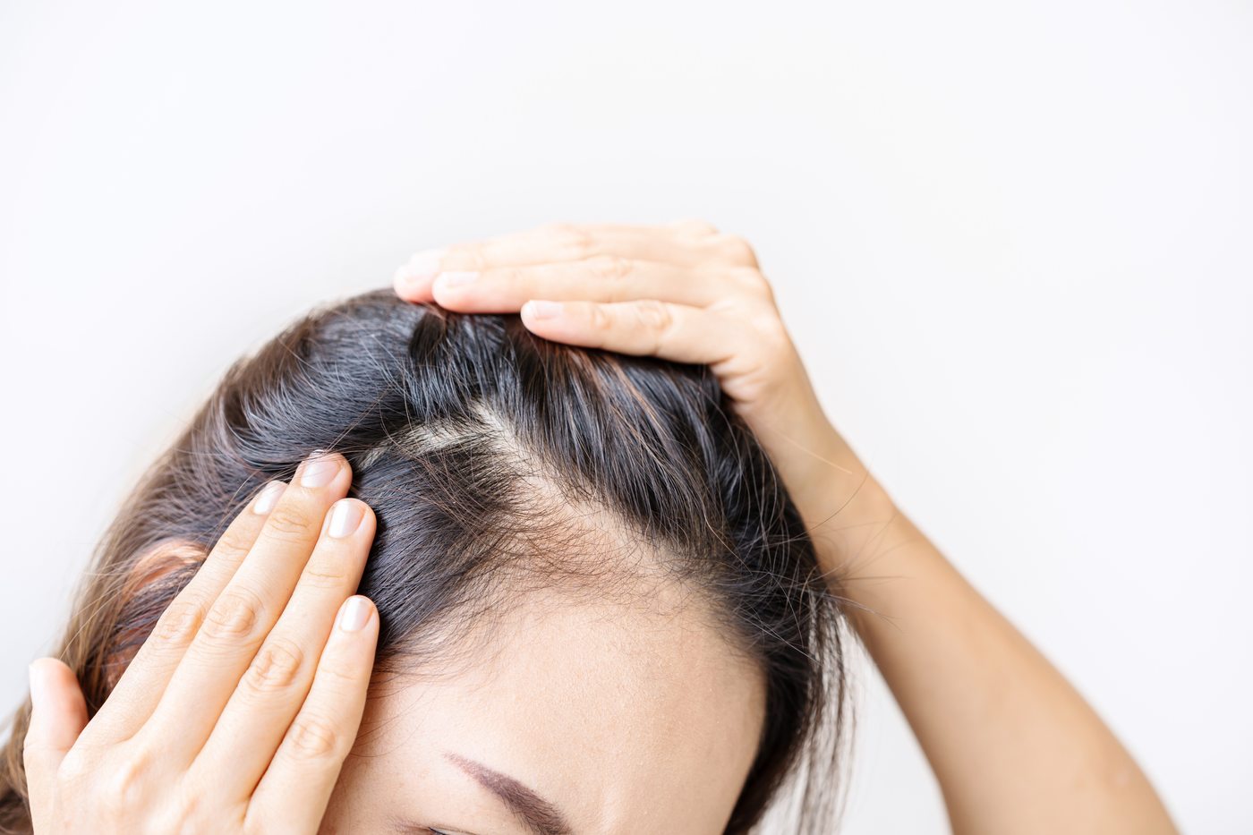Female hair loss treatment at Yuna Skin Clinic Melbourne