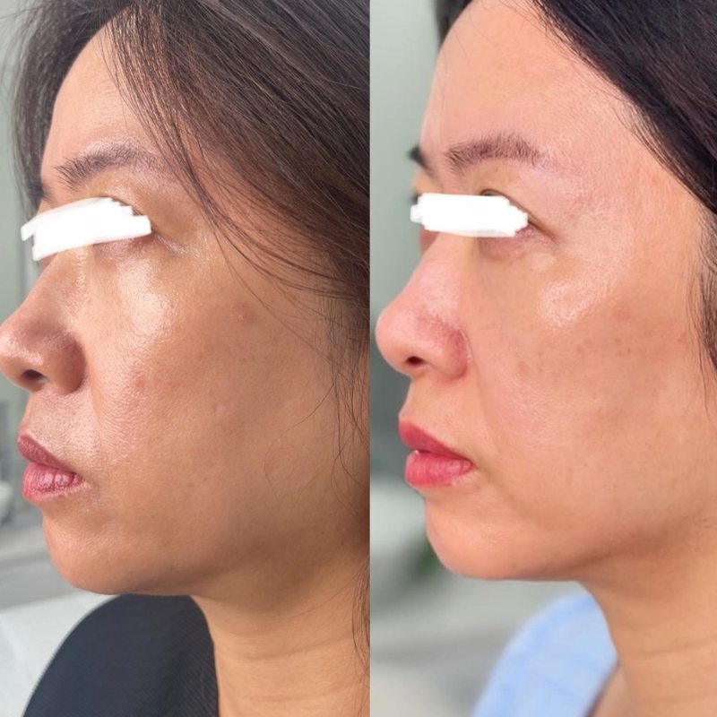 Before and after skin treatment results at Yuna Skin