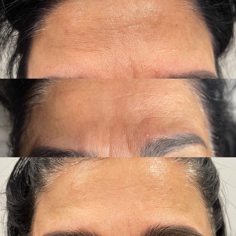 Forehead treatment results at Yuna Skin