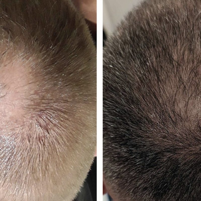 Hair loss treatment results at Yuna Skin