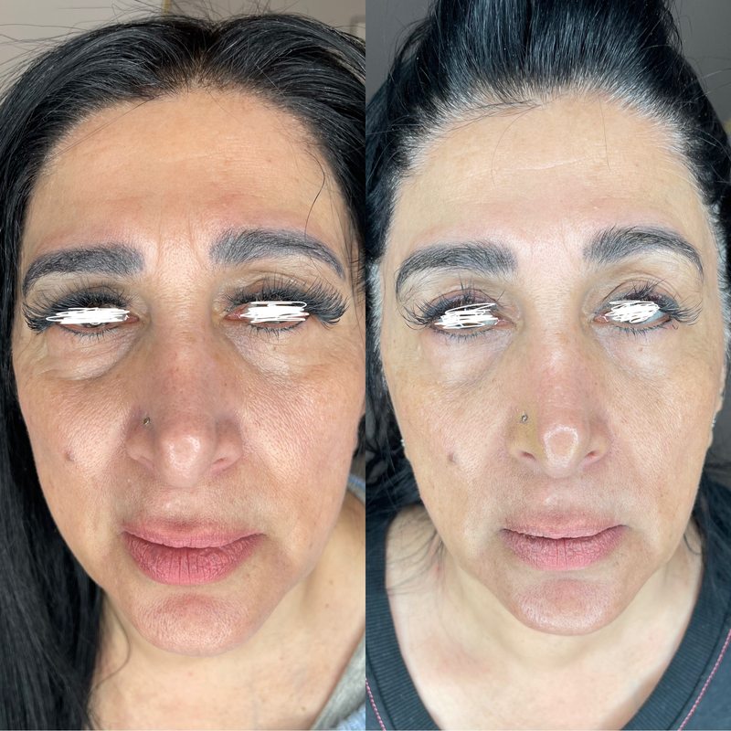 Before and after facial treatment at Yuna Skin