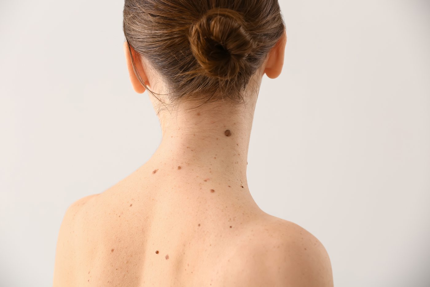 Skin lesion removal at Yuna Skin Clinic Melbourne