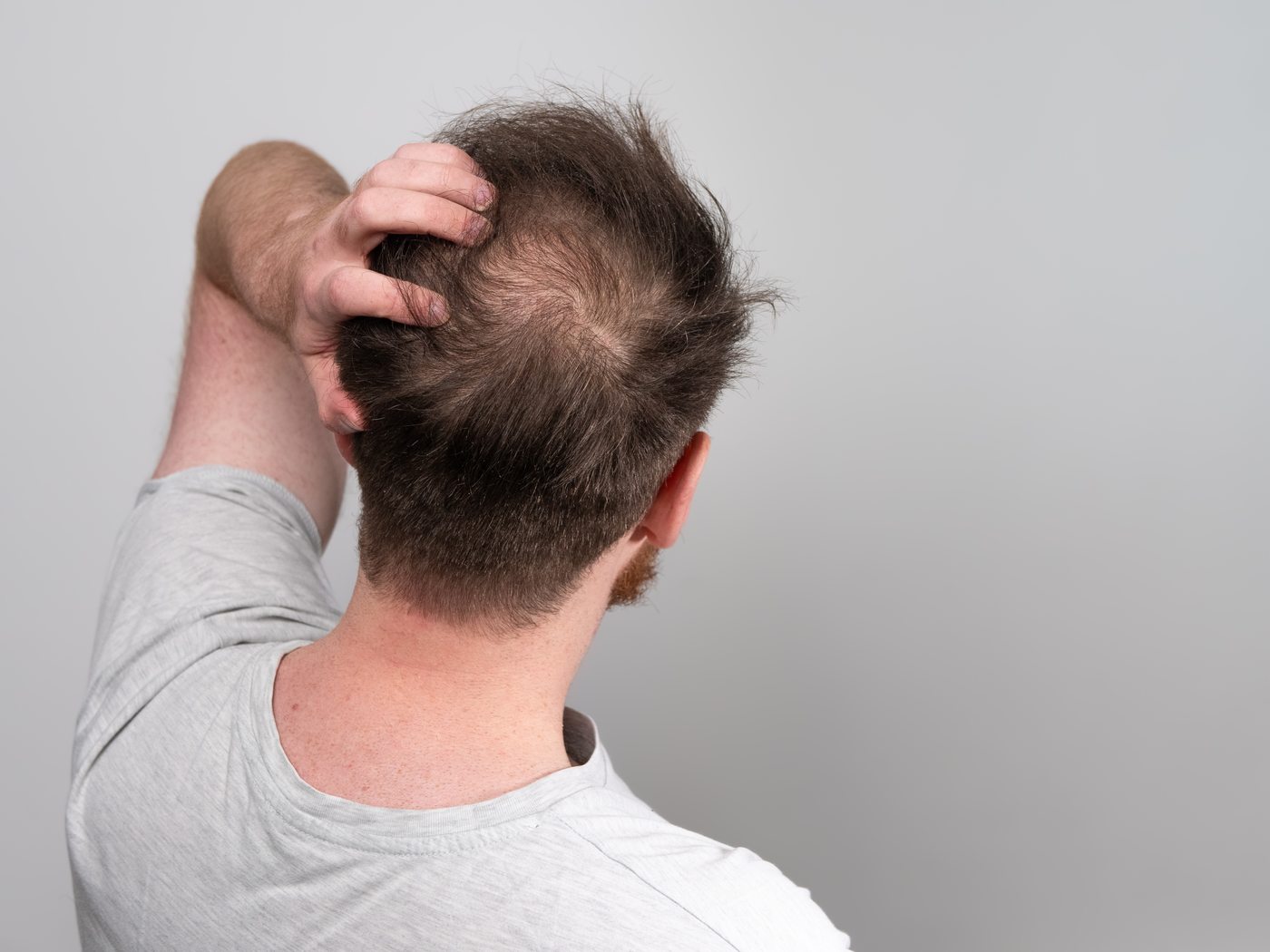 Male hair loss treatment at Yuna Skin Clinic Melbourne