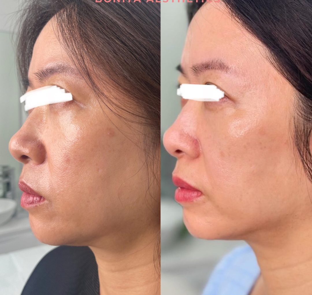 Plasma Fibroblast Results