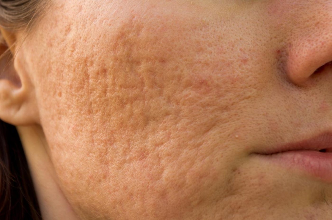 Scar treatment at Yuna Skin Clinic Melbourne