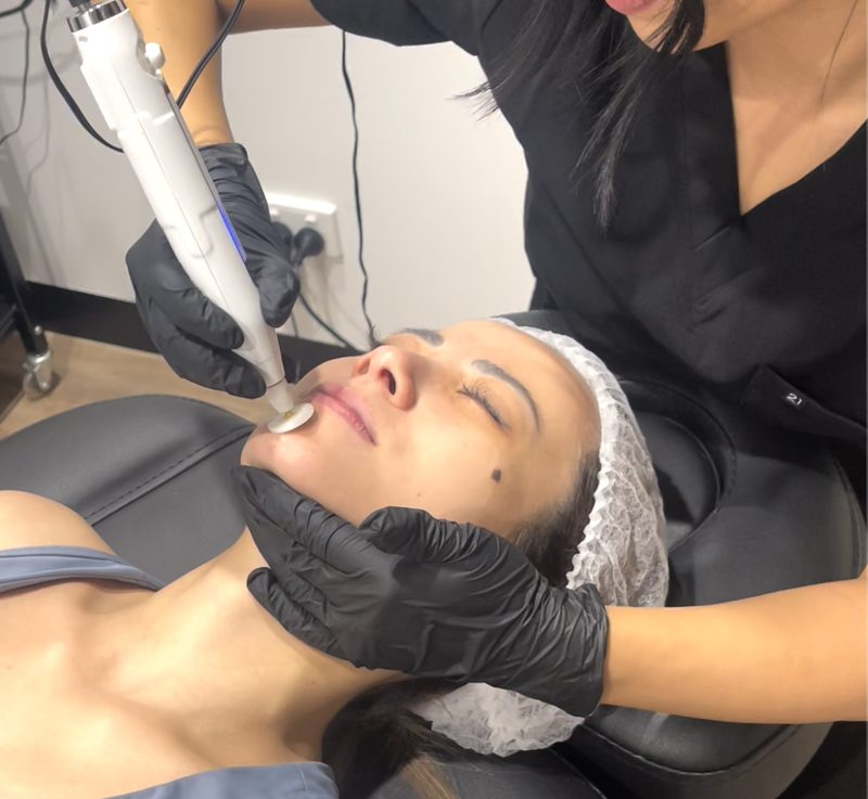 Korean Cold Plasma treatment at Yuna Skin Clinic