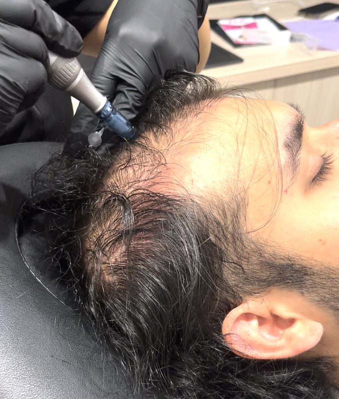 Exosome scalp treatment for hair loss at Yuna Skin Clinic