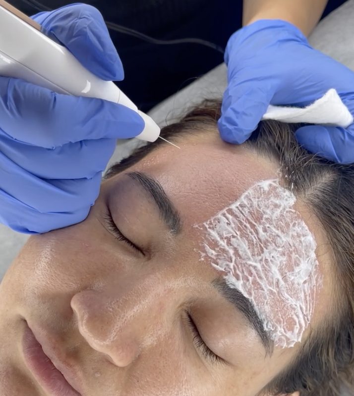 Plasma Fibroblast treatment at Yuna Skin Clinic